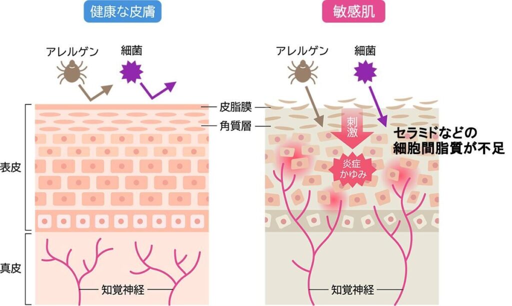 健康な皮膚と敏感肌の知覚神経の違い